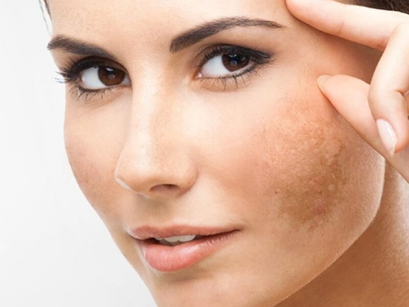 melasma