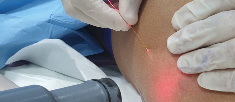 oblikovanje stražnjice - endolift